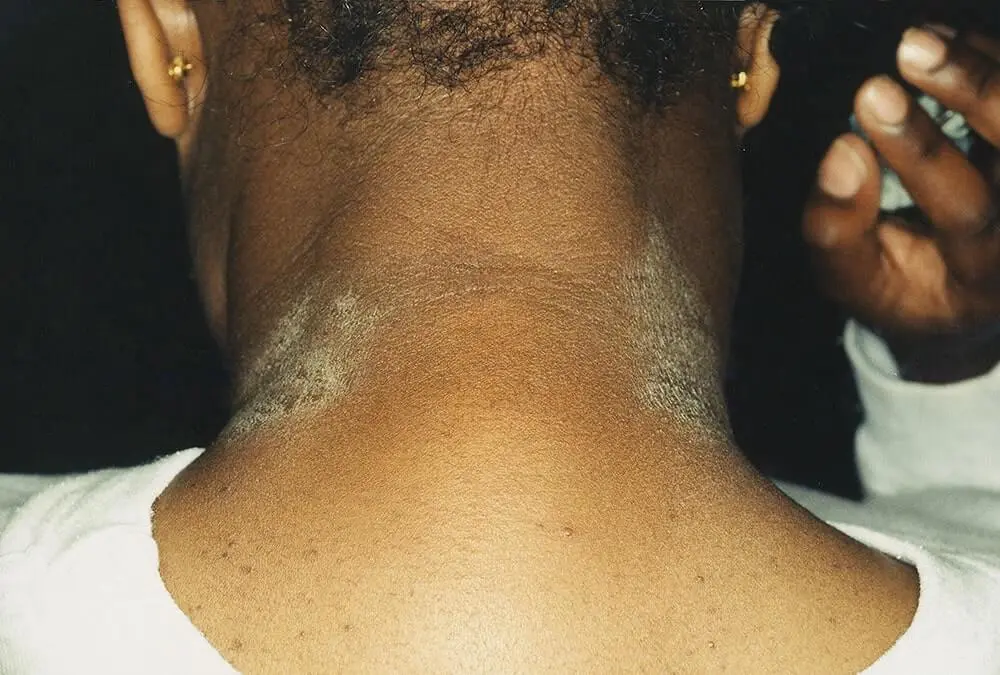The back of a person's neck that shows signs of eczema