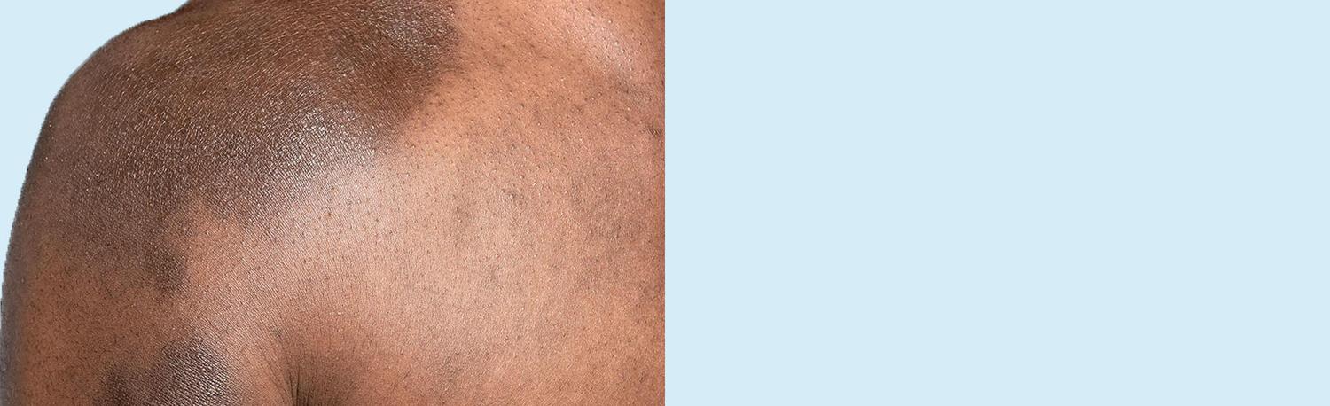 Une image du haut du corps d’une personne montrant des signes physiques d’eczéma