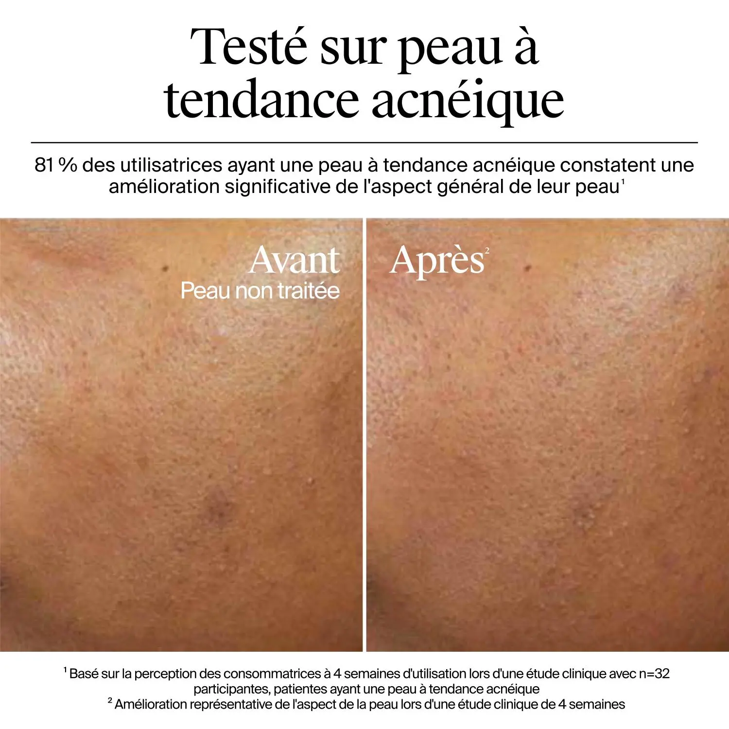 Résultats avant et après 4 semaines d’utilisation du gel-crème Neutrogena Hydro Boost sur une peau sujette à l’acné