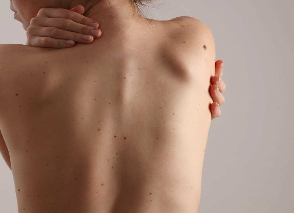 Person's bare back with moles and a statement on melanoma