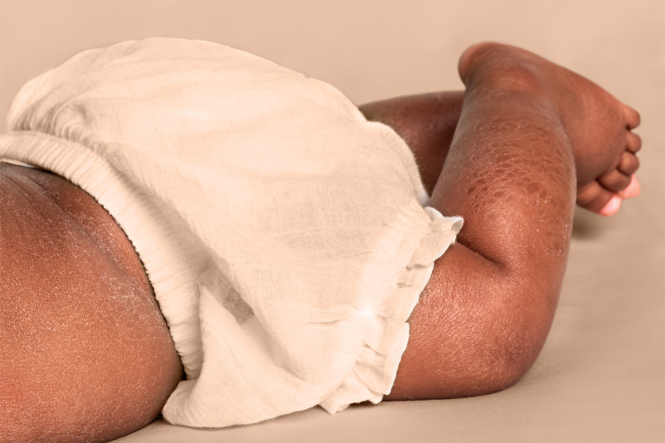 A baby’s lower leg showing signs of eczema