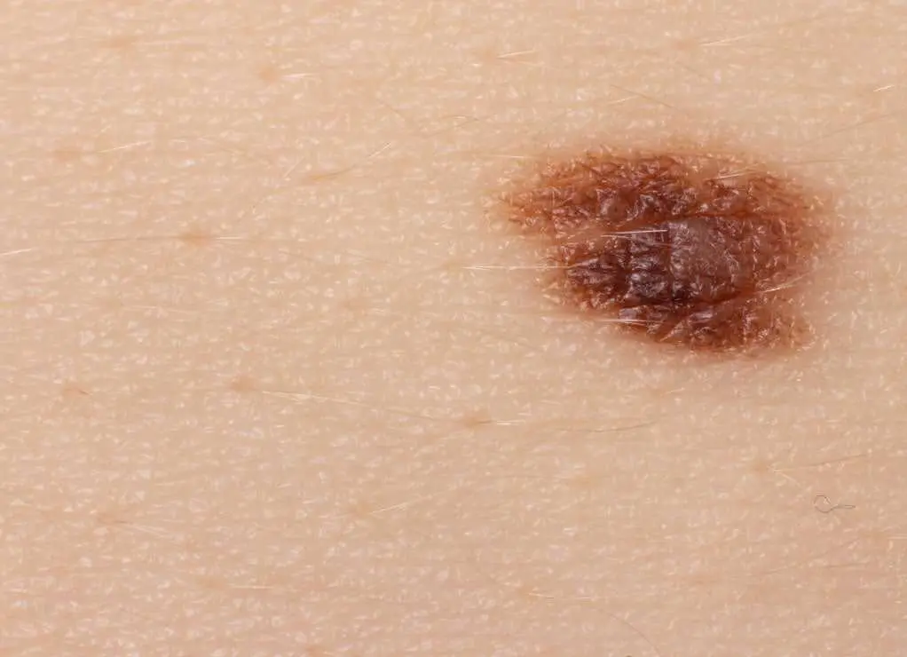 Signs of melanoma that shows uneven shape