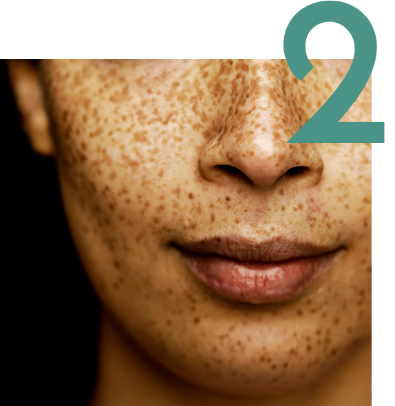 Person's  face with freckles and sun spots with the number two