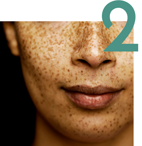Person's face with freckles and sun spots with the number two