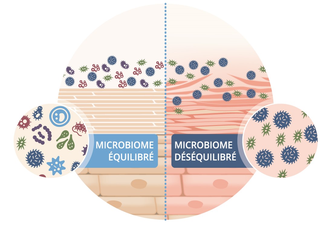 Un graphique microscopique montrant la différence entre un microbiome équilibré et déséquilibré