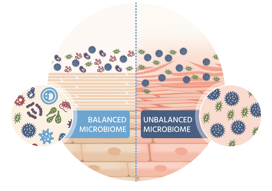 A microscopic graphic showing the difference between balanced and unbalanced microbiomes