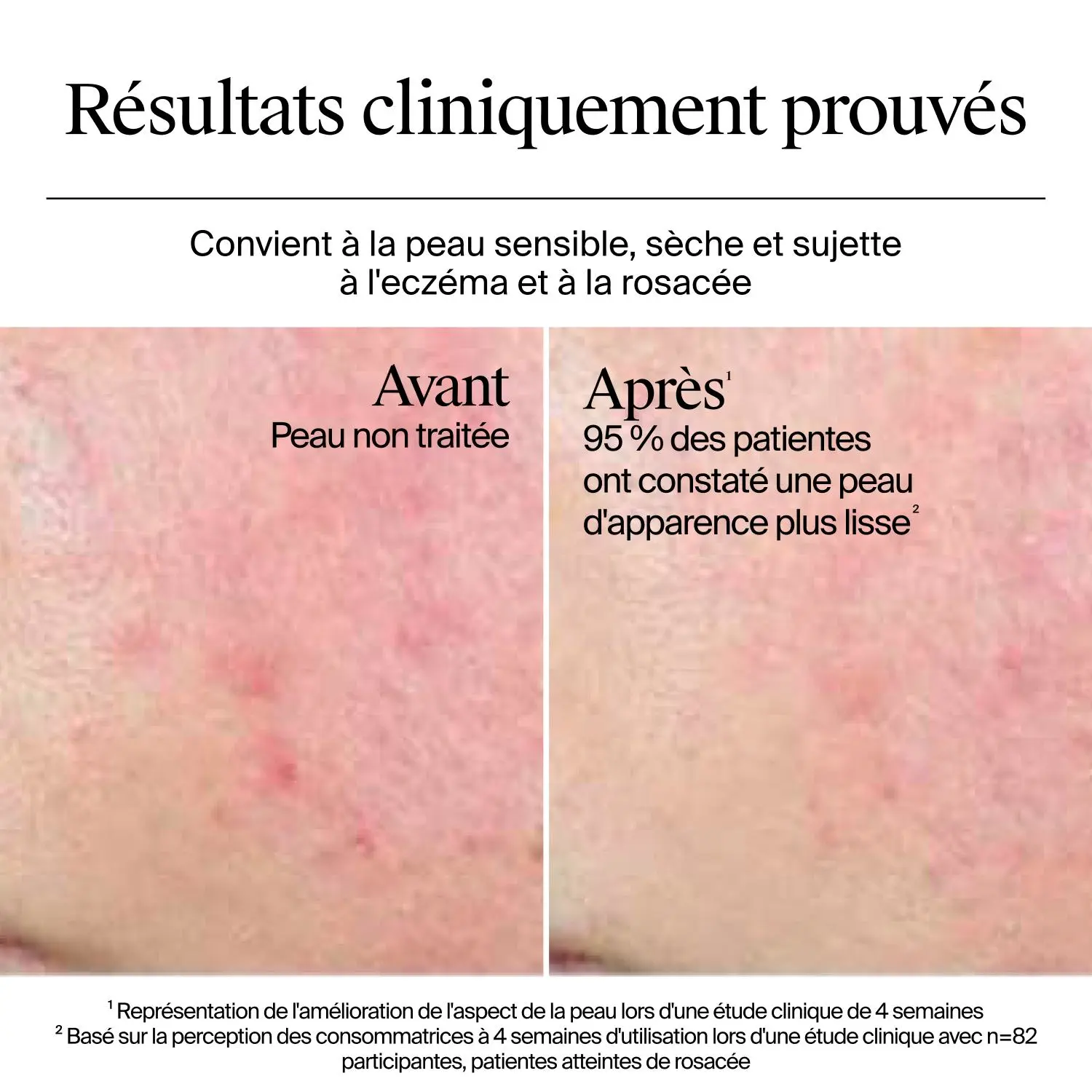 Résultats avant et après 4 semaines d’utilisation du gel-crème Neutrogena Hydro Boost sur une peau sensible, sèche, sujette à l’eczéma et à la rosacée