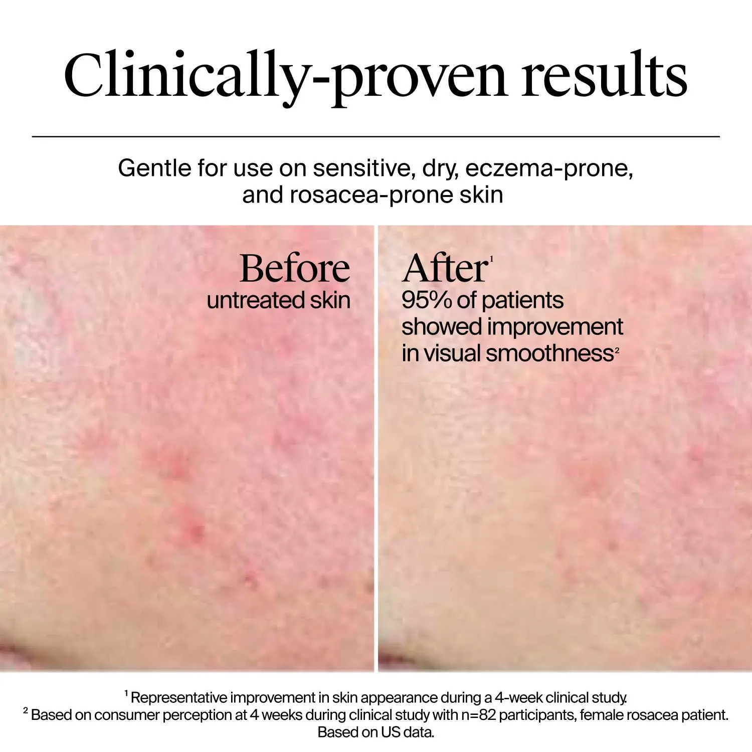 Before and after 4-week use of Neutrogena Hydro Boost Gel Cream on sensitive, dry, eczema, and rosacea-prone skin