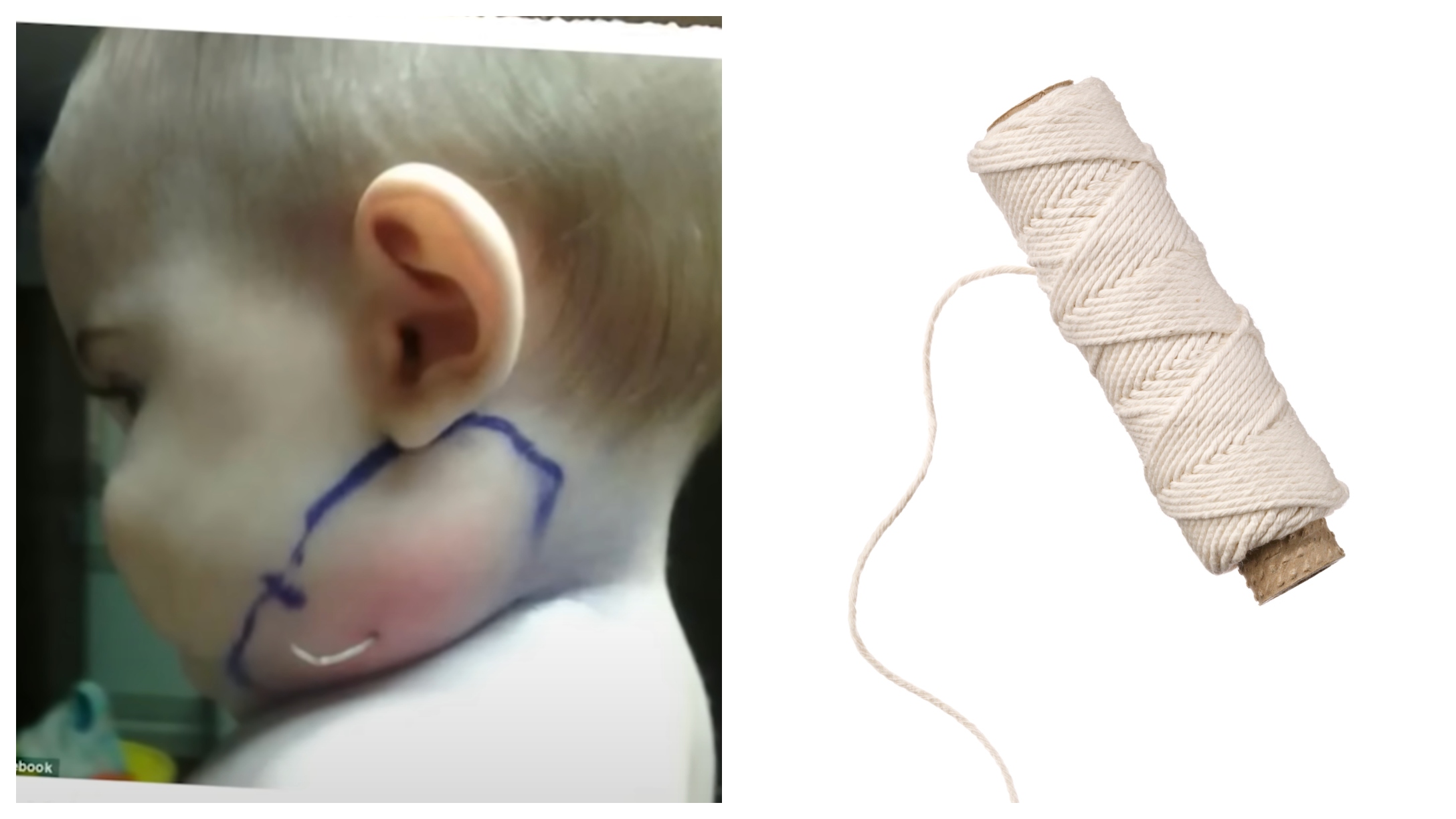 Mom Is Shocked To Find String Growing Out Of Baby's Face. Doctors Are