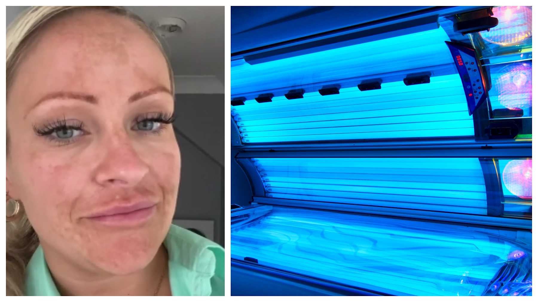 Woman Has Hole In Head After Developing Skin Cancer From Tanning Bed ...