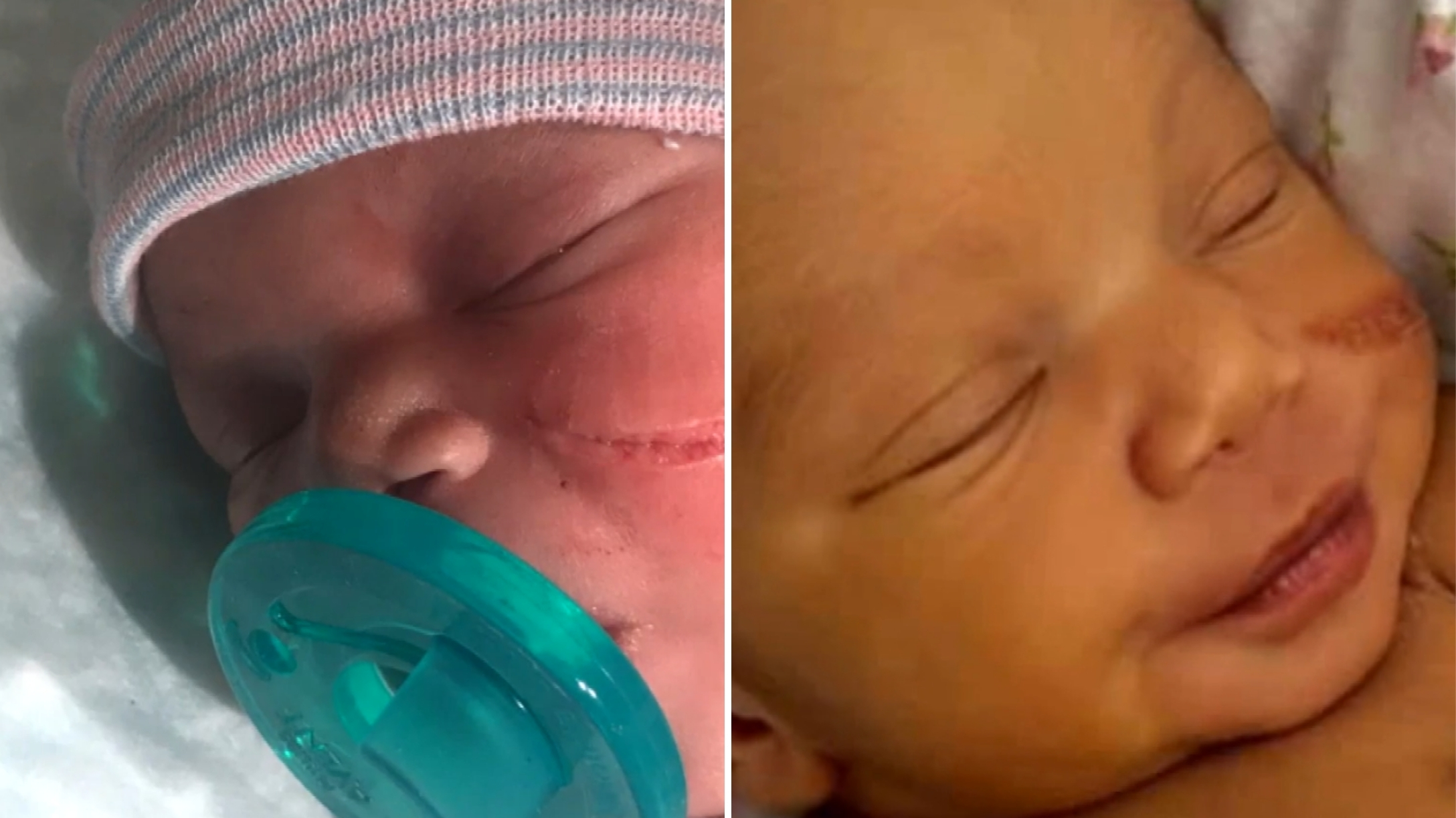 Denver Newborn Needed Stitches After Her Face Was Cut By Scalpel During