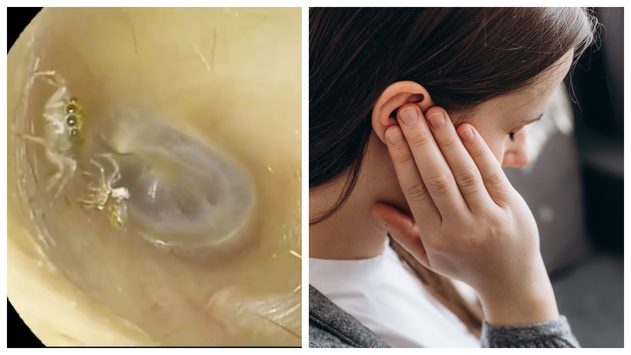 Woman Hears Clicking Sound In Her Ear, Doctor Finds Spider In Her Ear