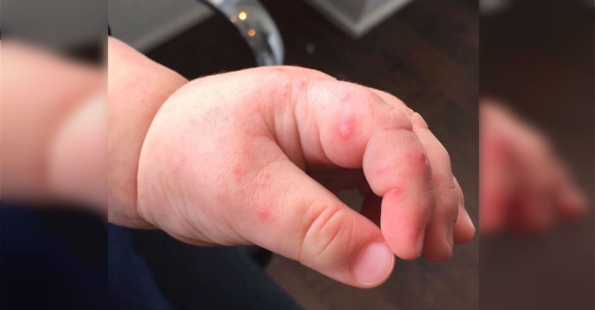Mom Noticed A Blister On Her Baby's Hand, But Never Expected Doctors To