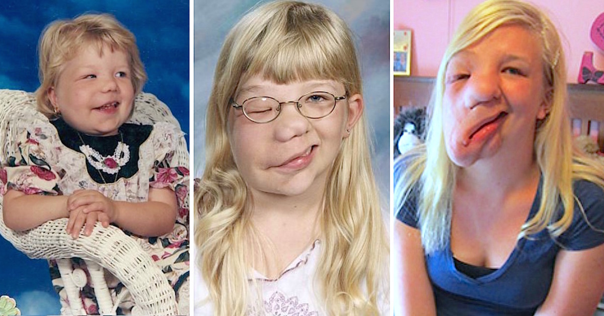 Teen Bullied Over 'Drooping' Face Finally Gets The Help She Needs