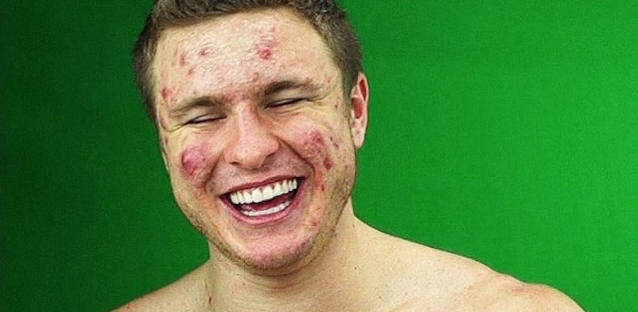 Young Man With Severe Acne Reveals Secrets Behind His Amazing