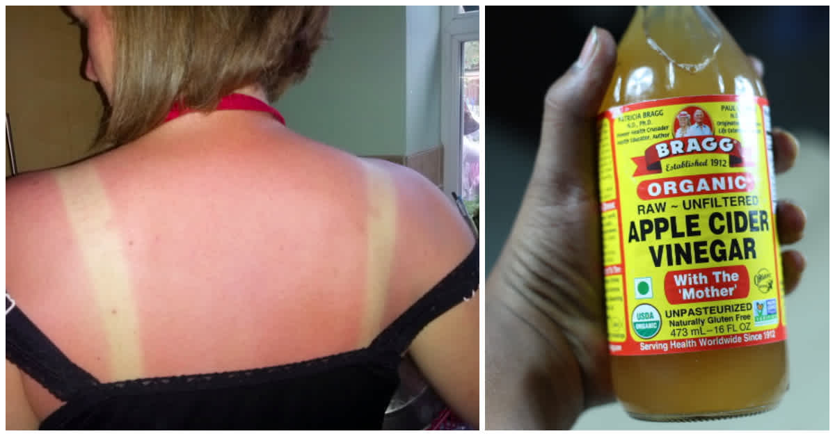 Apple Cider Vinegar for Sunburn: Can it Really Help in Curing the  Condition? - NDTV Food