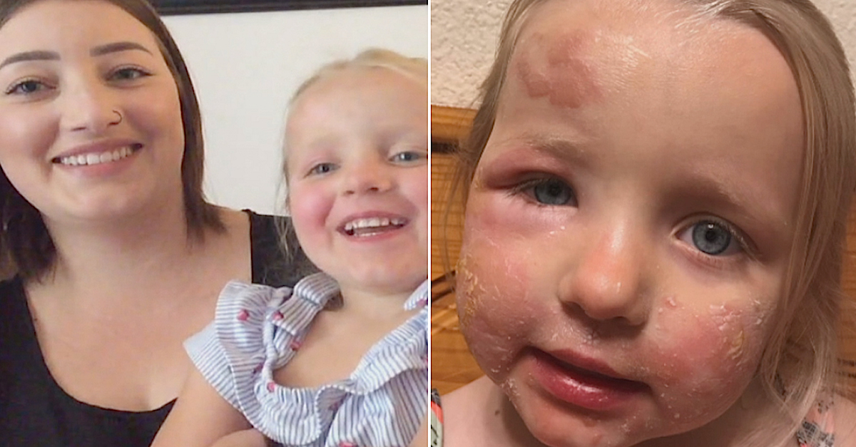 3YearOld Contracts Painful 'Margarita Burn' Skin Blisters