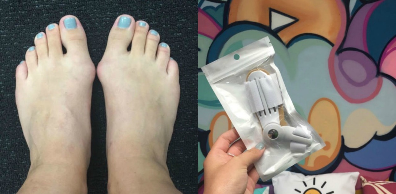 bunion splint you can wear with shoes