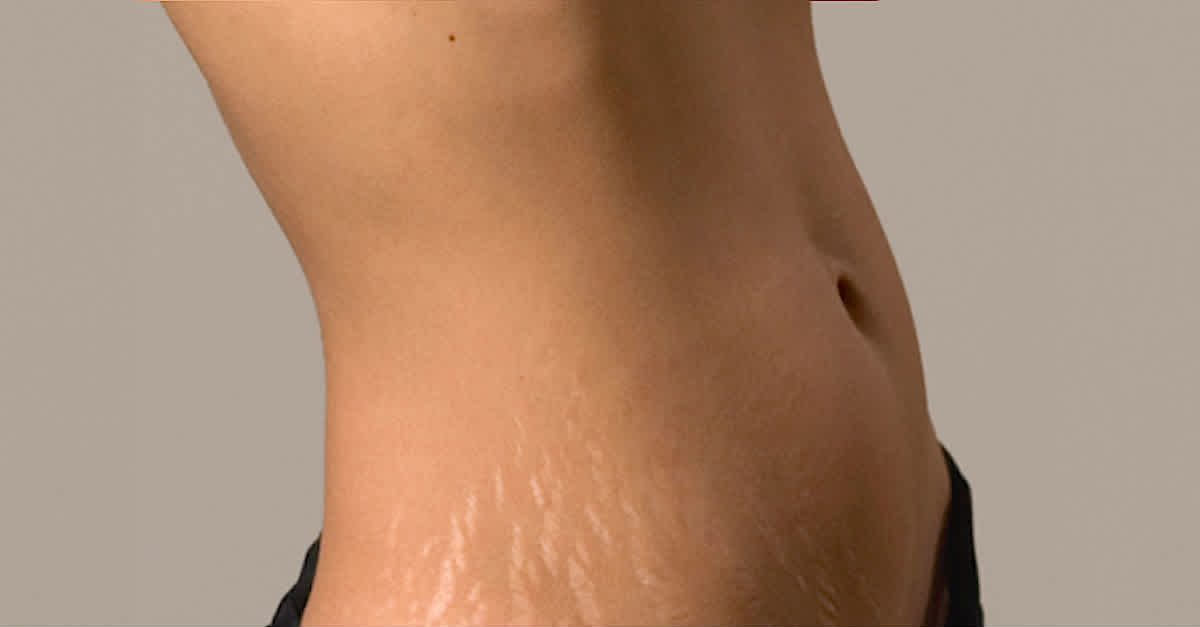 10 Remedies To Get Rid Of Stretch Mark And It Actually Works 
