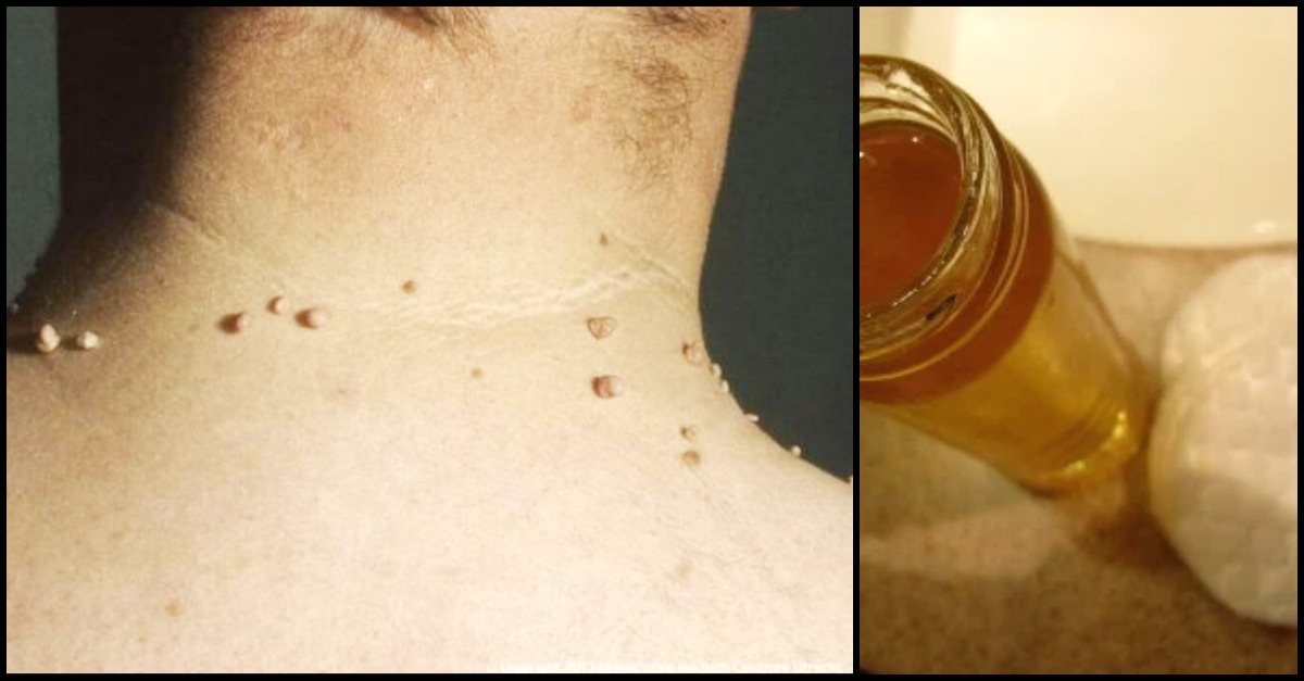 How To Remove Skin Tags At Home With Apple Cider Vinegar | LittleThings.com