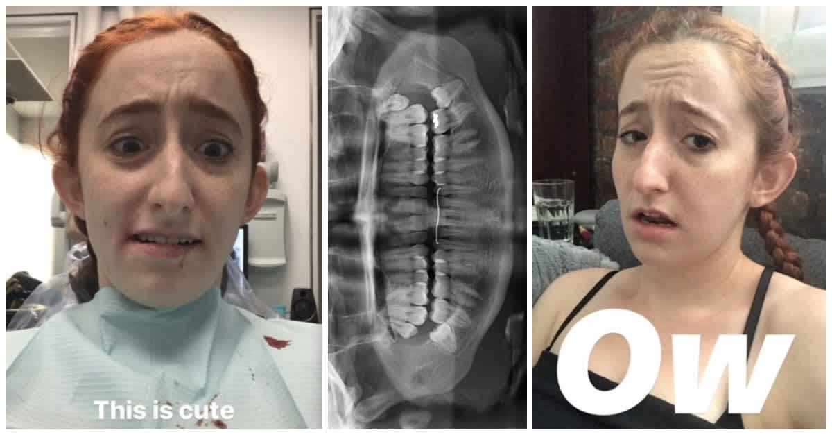 How Long Does Paresthesia Last After Wisdom Tooth Extraction How Long Does Paresthesia Last After Wisdom Tooth Extraction