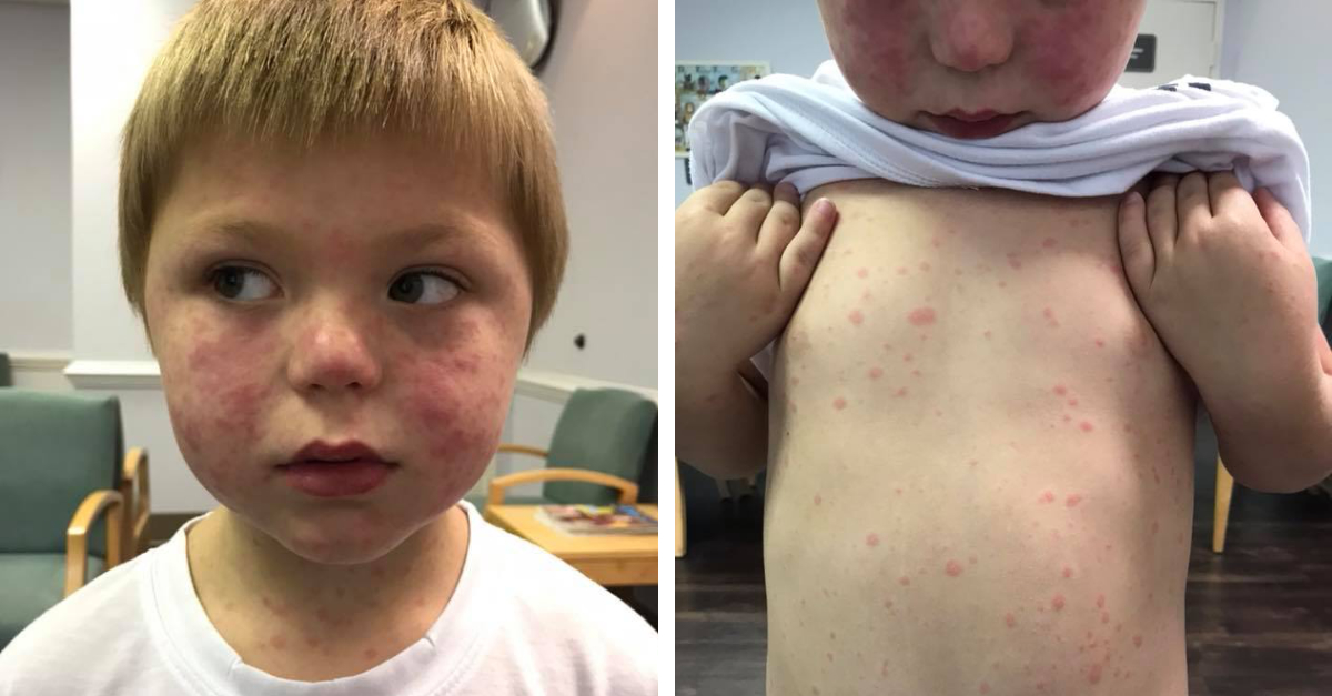 Mom Pens Warning After 5-Year-Old Gets Rare Disease From Tick Bite ...