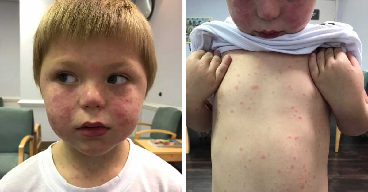 Tick Rmsf Rash Mom Pens Warning After 5-Year-Old Gets Rare Disease From Tick Bite ...
