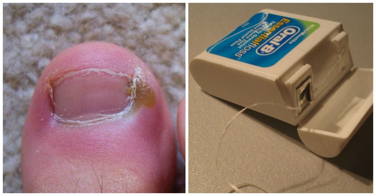 6 Surprisingly Effective Home Remedies For Ingrown Toenails