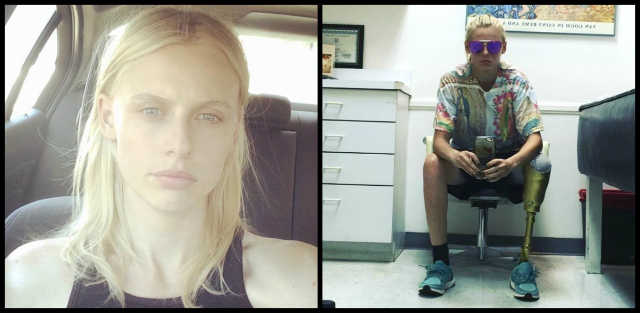 Toxic Shock Syndrome-Stricken Model Will Lose 2nd Leg Too ...