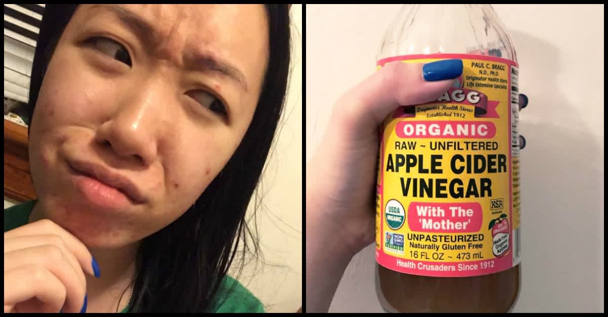 Does Vinegar Help Acne  