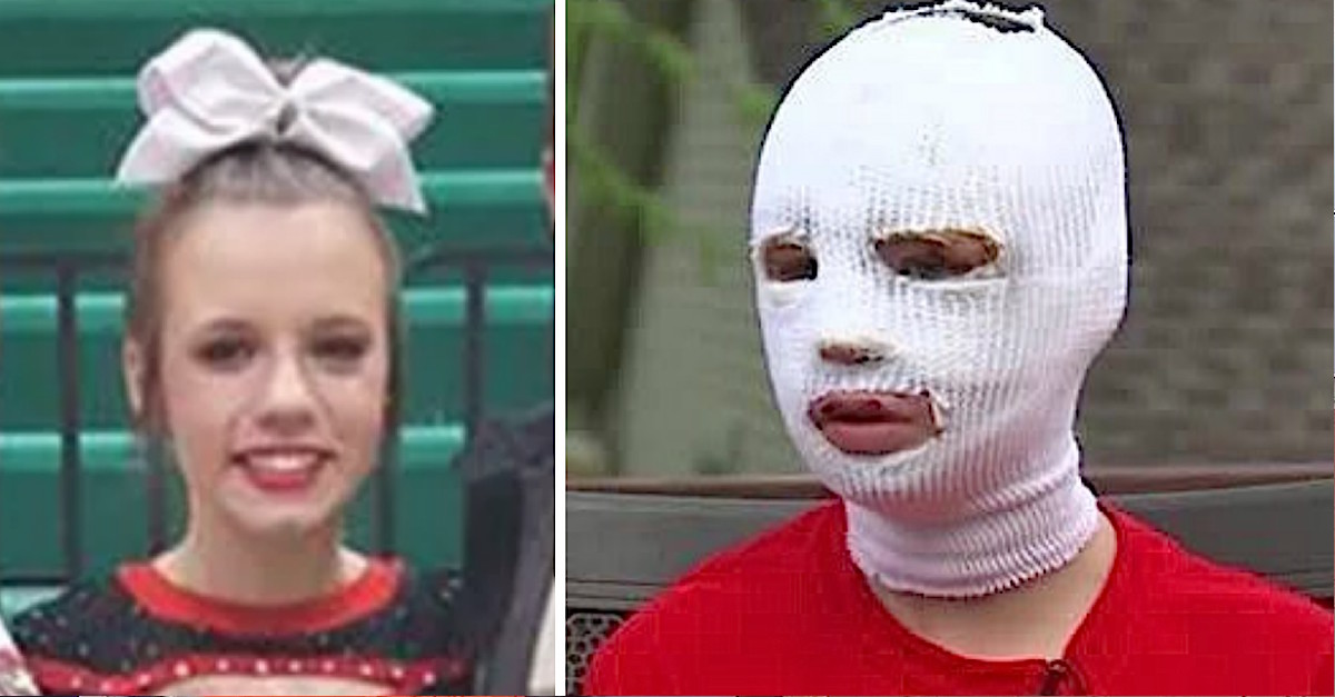 Teen Burned In Bonfire Refuses To Go To Prom But Her Date Shows Up