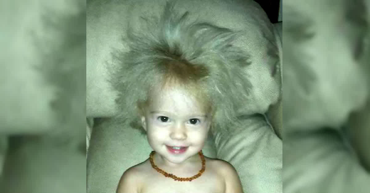Baby With Crazy Hair Has Same Gene Disorder As Einstein | LittleThings.com