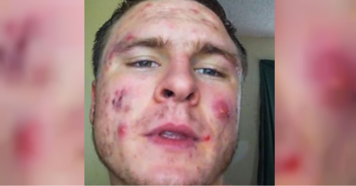 Young Man With Severe Acne Reveals Secrets Behind His Amazing