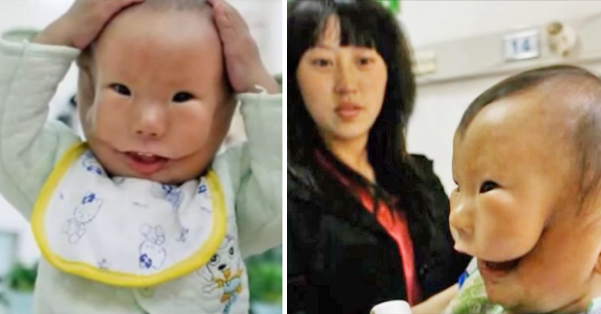 Mom Cries When She Sees Newborn With 'Mask Face' For The First Time