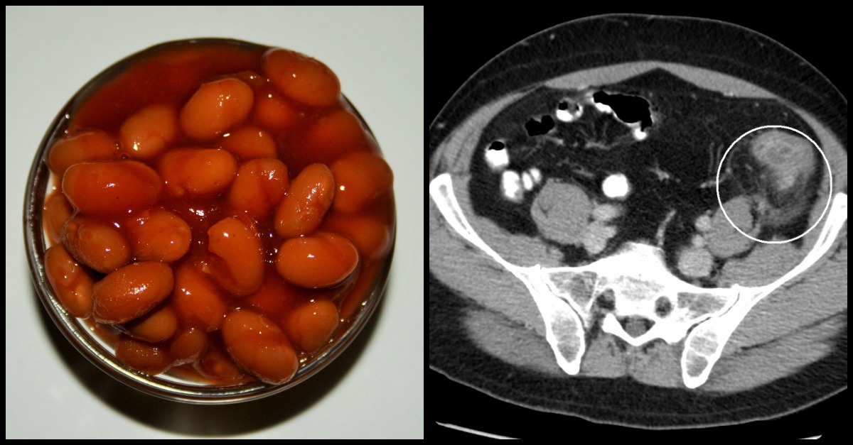 Baked Beans Nutritional Benefits You Didn't Know