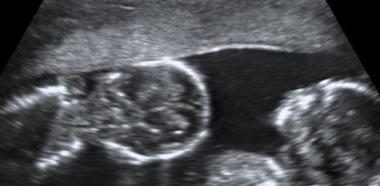 Do Babies Pee In The Womb? 10 Weird Things That Happen