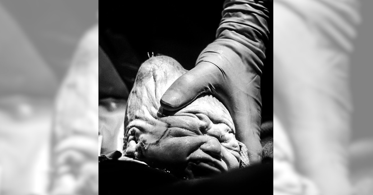 Baby Has Extreme Head Molding After Birth