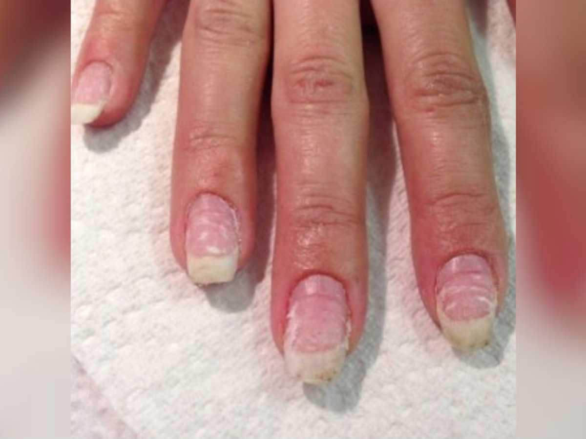11 DIY Methods To Get Rid Of Yellow Nails 