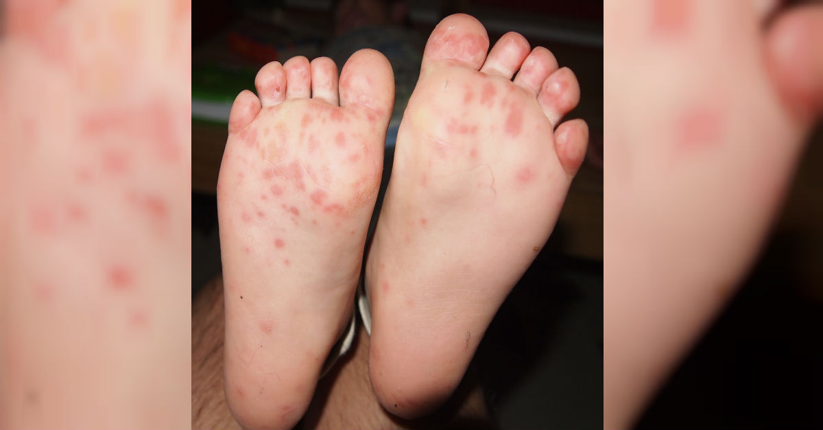 Parents Urged To Know The Signs Of HandFootAndMouth Disease