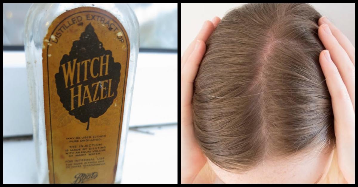 Dab Witch Hazel On Your Dry, Itchy Scalp To Help Soothe Dandruff
