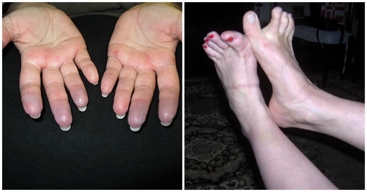 her hands and feet are always purple what it means i had no idea littlethings com