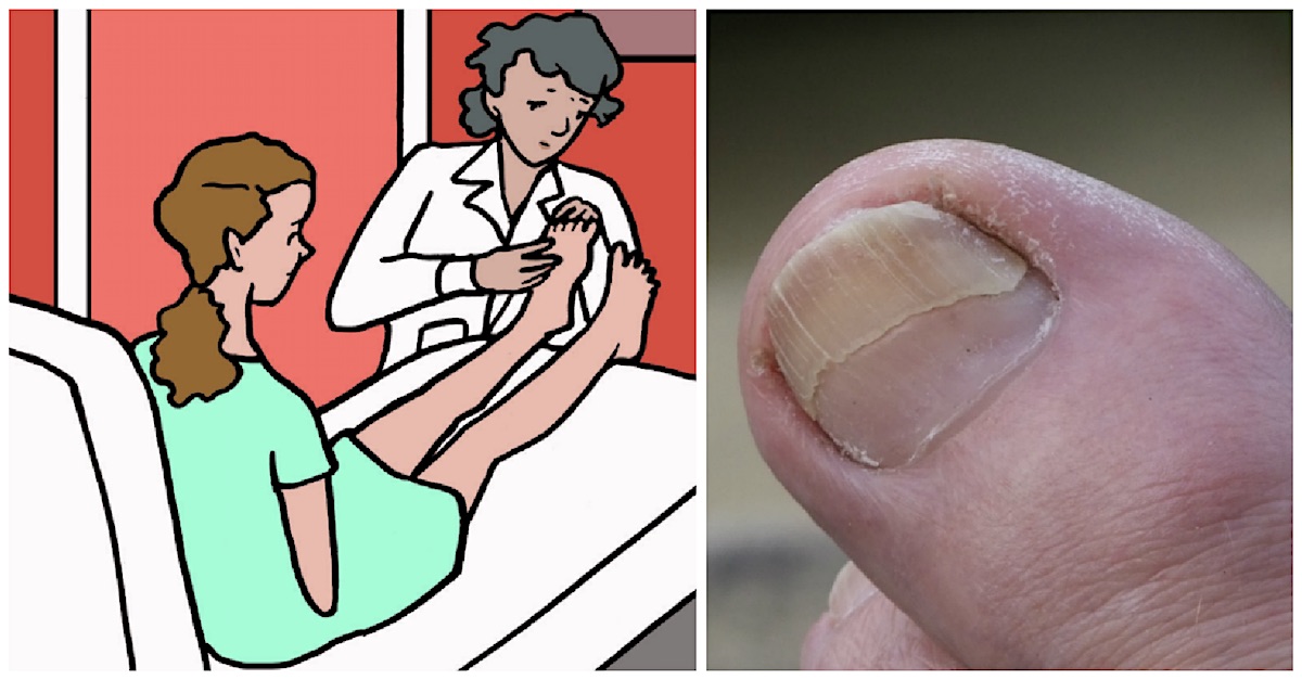 6 Reasons That Women Shouldn't Ignore A Toenail That Falls Off