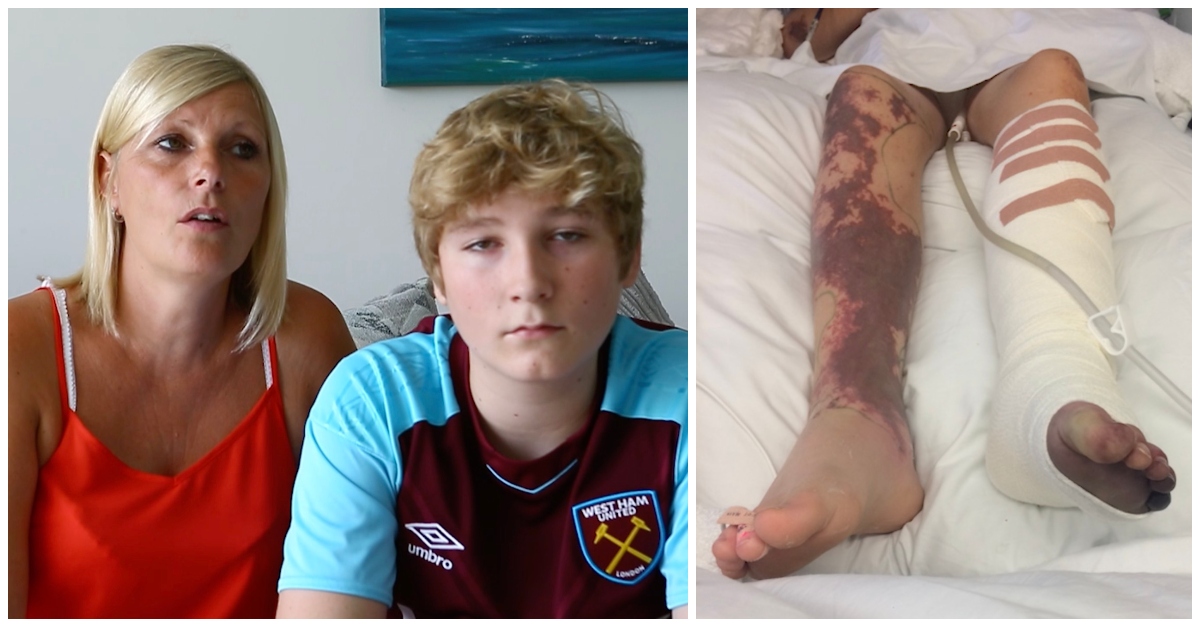 Teen Rushed To Hospital After Eating Fried Chicken Terrifying Diagnosis Leads To Loss Of Limbs Littlethings Com