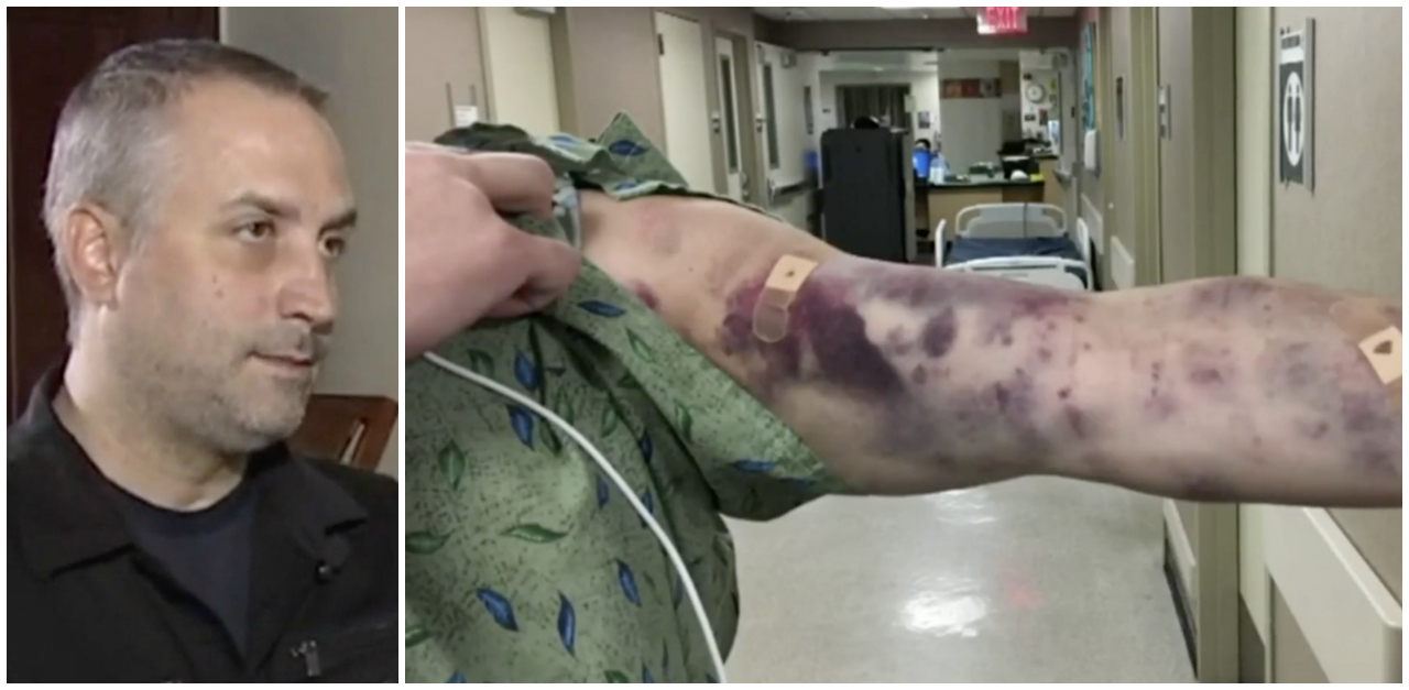Bug Bites Arizona Man And Causes Huge Arm Bruises | LittleThings.com