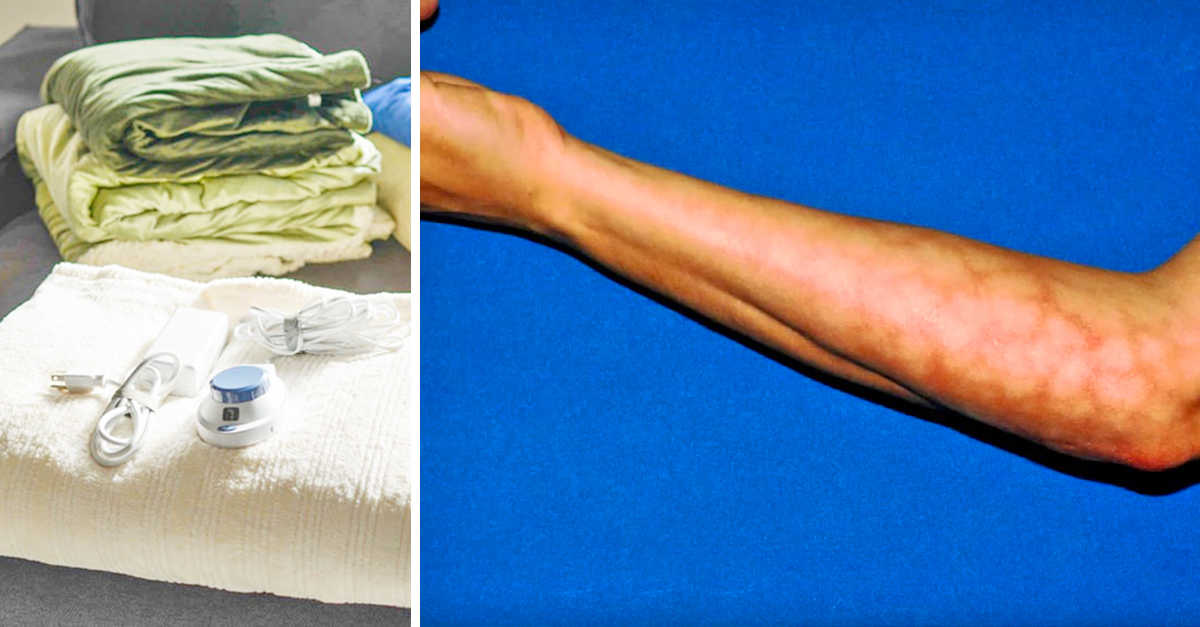 Toasted Skin Syndrome Caused By Heated Blanket Littlethings Com Toasted Skin Syndrome Caused By Heated Blanket Littlethings Com