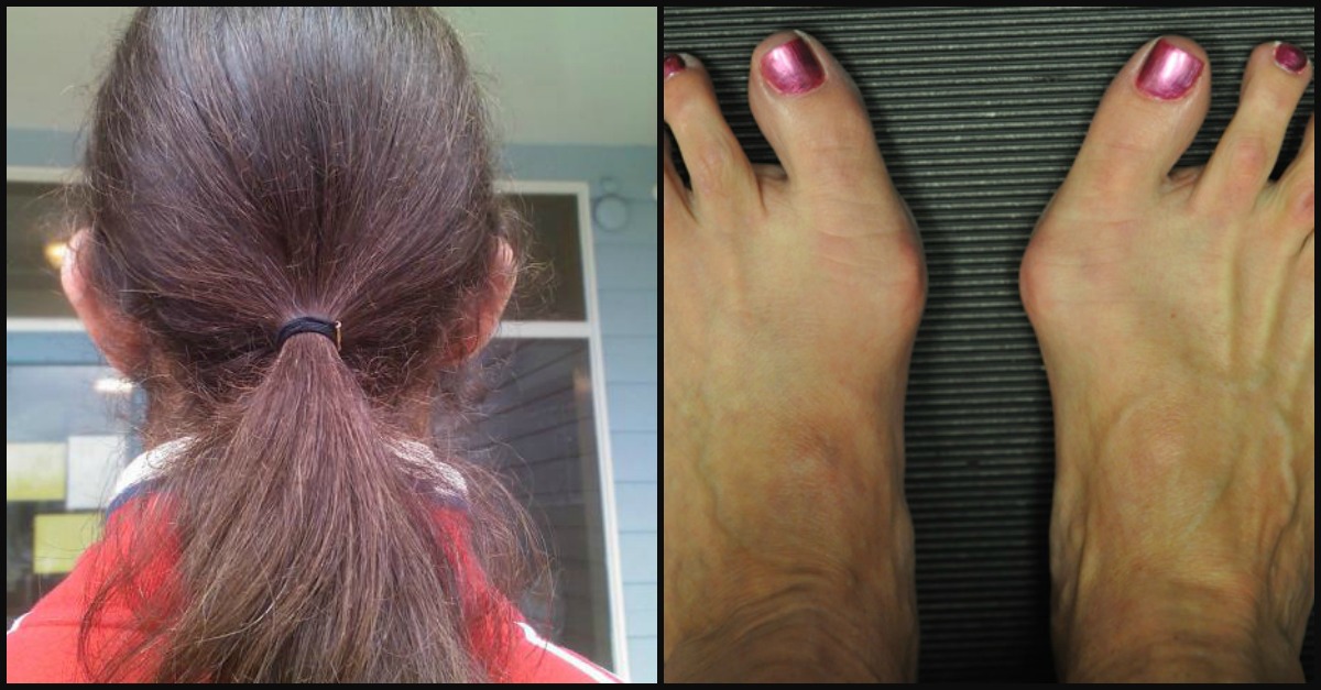 How To Prevent Bunions With 8 Simple Tips | LittleThings.com
