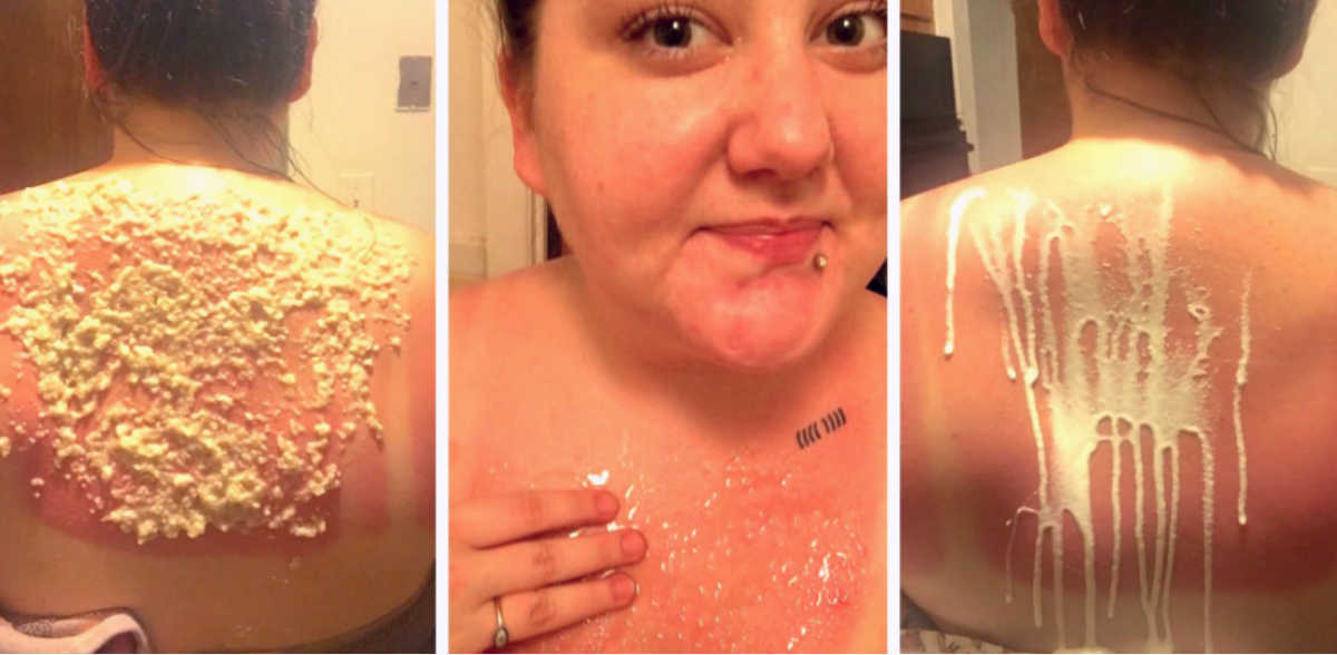 I Tried 8 Sunburn Home Remedies To See Which Worked