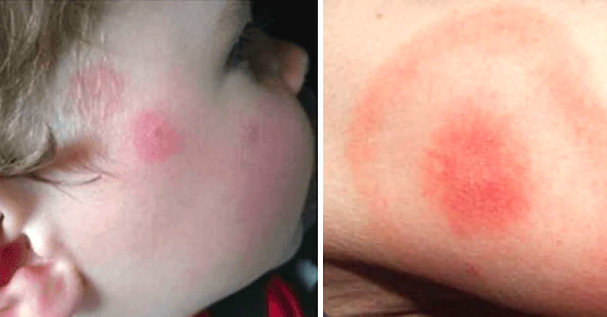Her Son's Lyme Disease Is Almost Mistaken For A Simple Rash After His ...