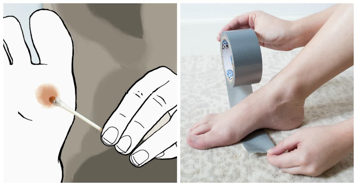 The Best Duct Tape for Wart Removal