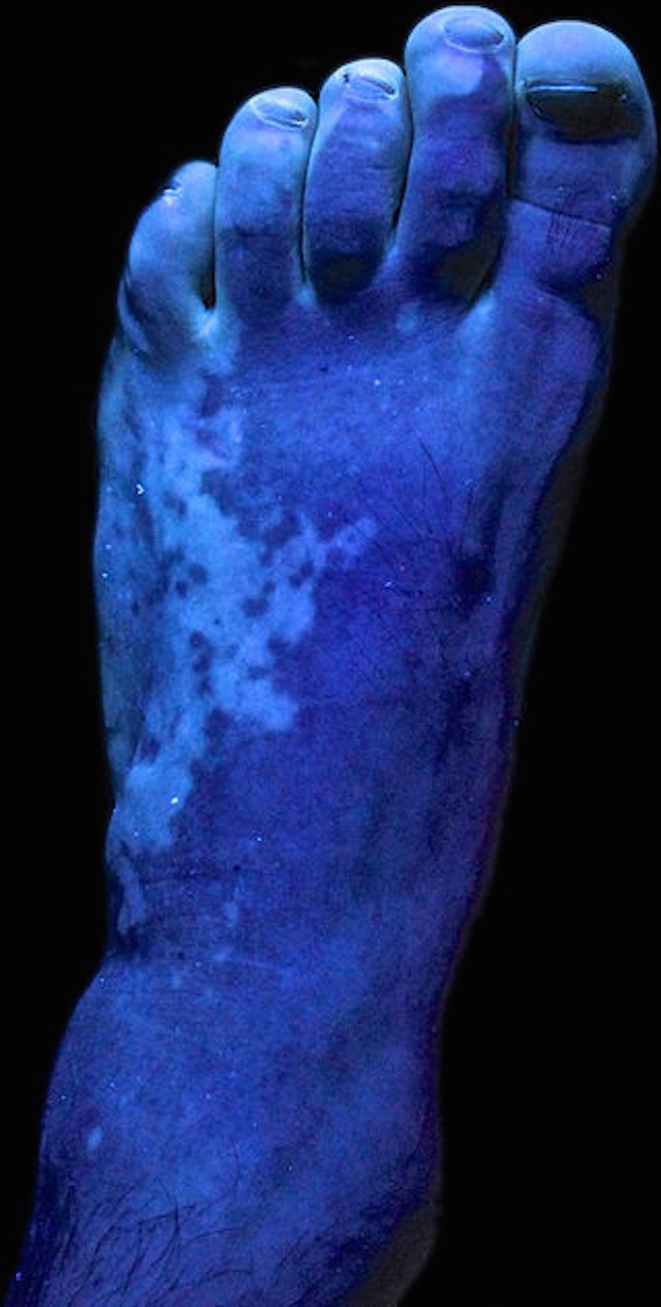 uv light athlete's foot